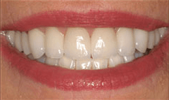 Close up of smile with whiter and more aligned teeth