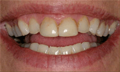 Close up of smile with slightly misaligned and discolored teeth