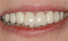 Smile with newly restored teeth
