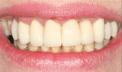 Smile with whiter and restored teeth