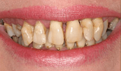 Smile with yellowed and damaged teeth