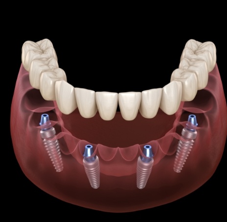 Illustrated full denture being placed onto four dental implants