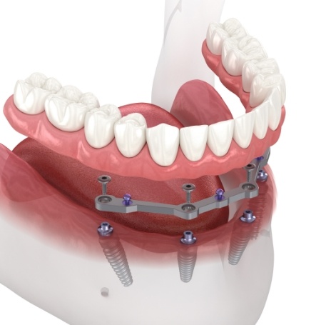 Illustrated All on 4 implant denture being placed