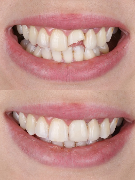 A smile before and after cosmetic dental bonding