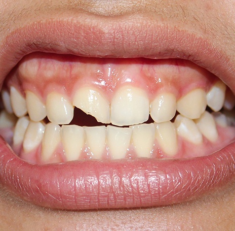 A man with a chipped tooth