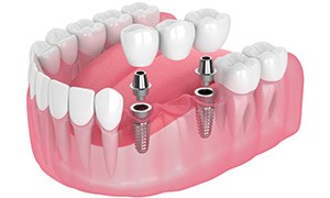 Illustration of implant bridge