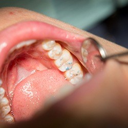 Closeup of patient receiving metal free dental restoration