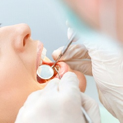Closeup of woman getting a dental crown in Rock Hill