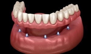 Model of implant dentures in Rock Hill, SC with four posts