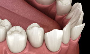 Illustration of crowded teeth