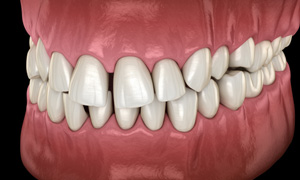 Illustration of gapped teeth