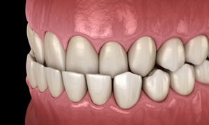 Illustration of an underbite