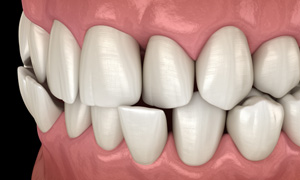 Illustration of a crossbite