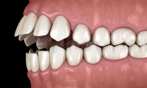 Illustration of an open bite