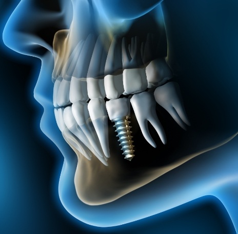 Illustrated x ray of a person with a dental implant replacing a missing lower tooth