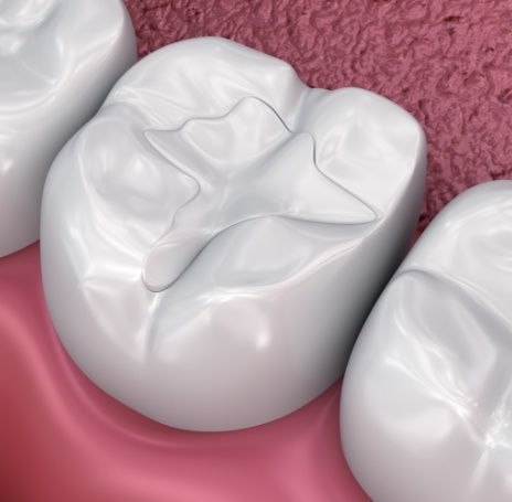 tooth-colored dental crowns