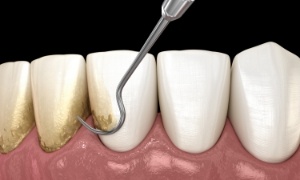 Man with thumbs up in dentist’s chair after periodontal therapy