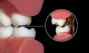 Model of jaws that are misaligned