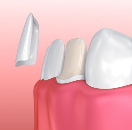 Woman's smile compared with veneer shade chart