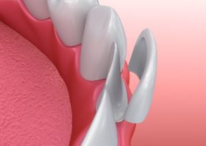 Model of a veneer being placed on a front tooth