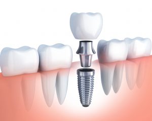 diagram of a dental implant