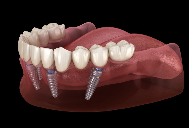 Illustration of dentures supported by All-on-4 implants