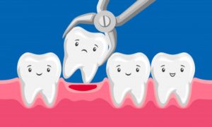 tooth extraction illustration