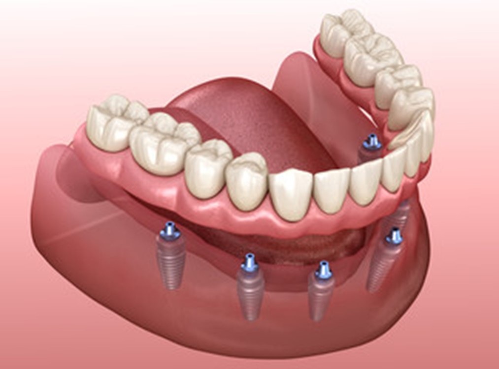illustration of implant dentures