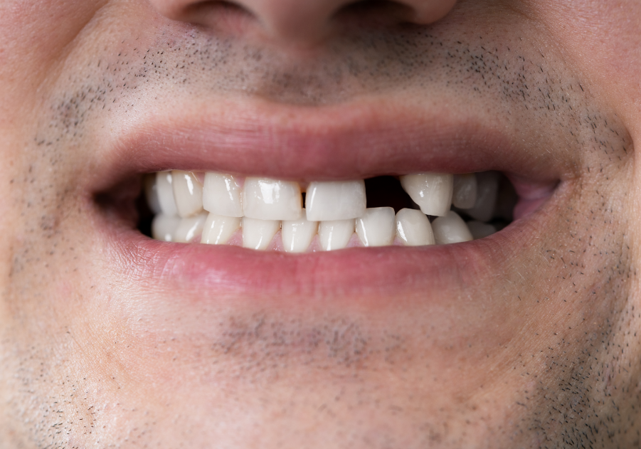 Man with missing tooth