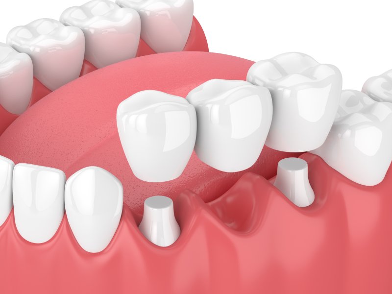 Illustration of dental bridge and treated teeth