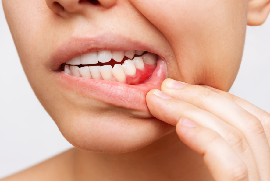 Close up of mouth with inflamed gums